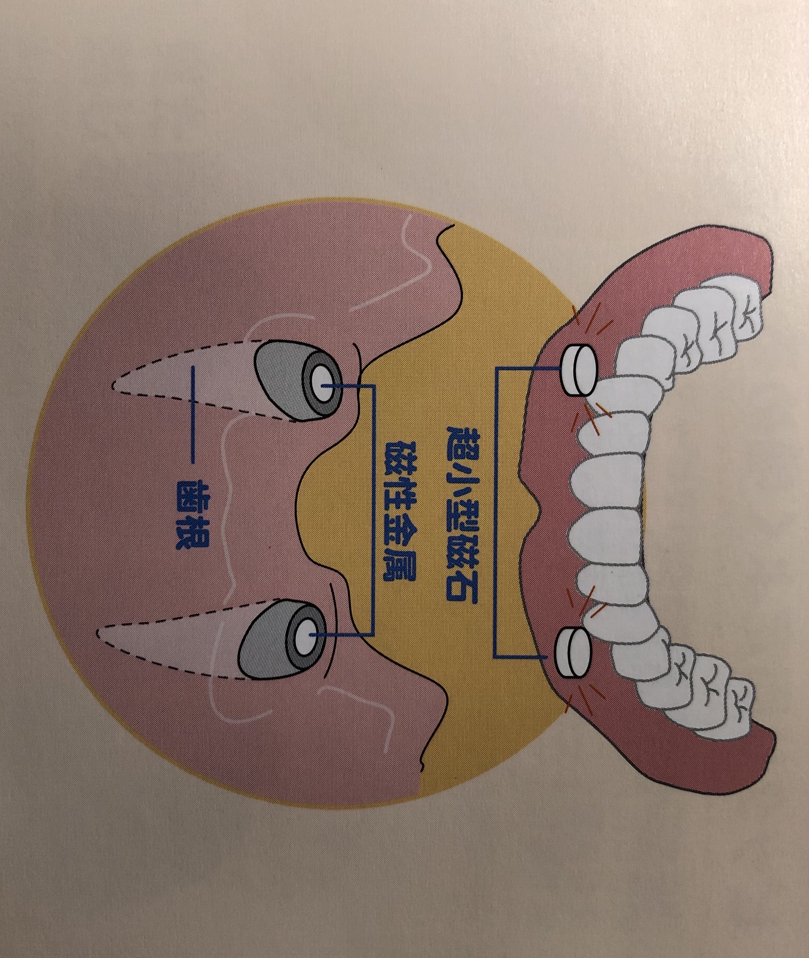 磁石式入れ歯１