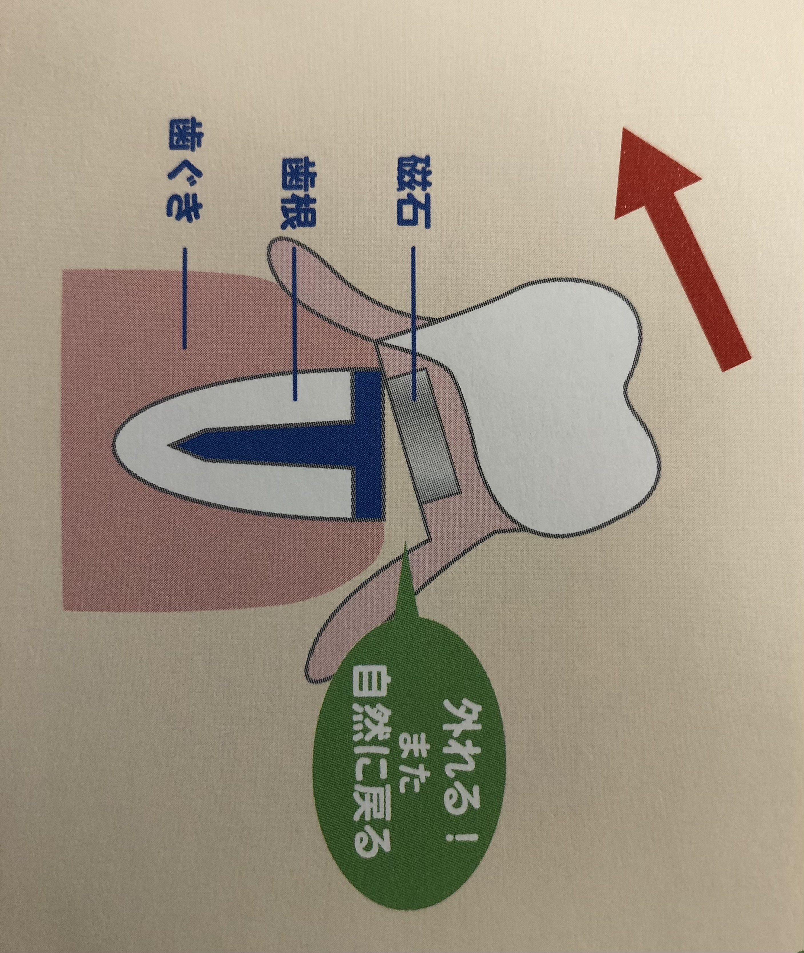 磁石式入れ歯２